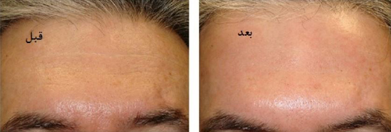 لیزر چروک پیشانی