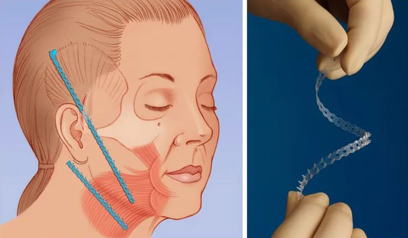 اندوتاین صورت