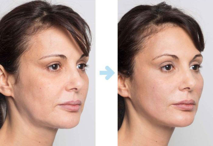 نخ جوانسازی و لیفت صورت