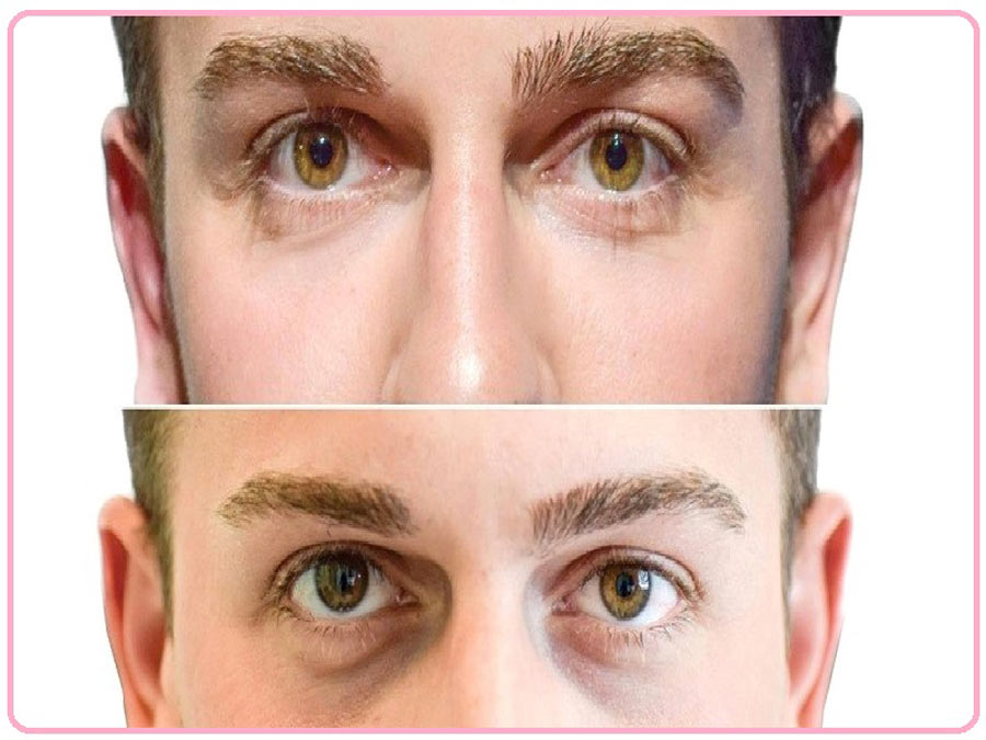 رفع گودی زیر چشم