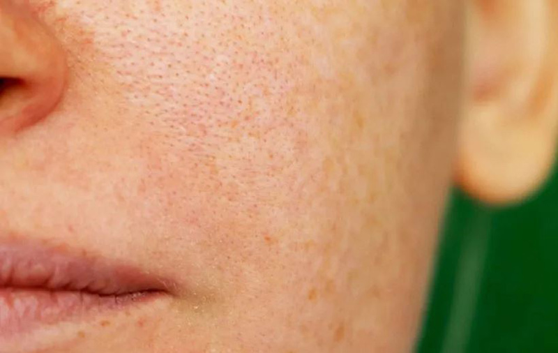 رفع منافذ باز پوست صورت