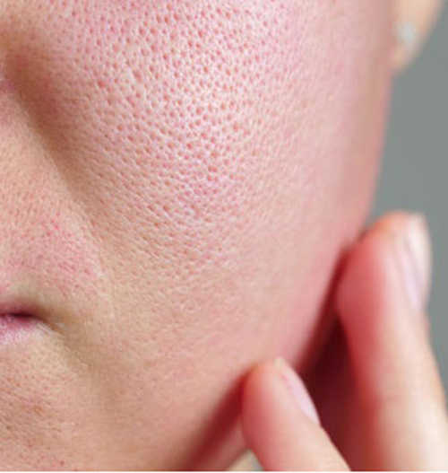 بستن منافذ باز پوست