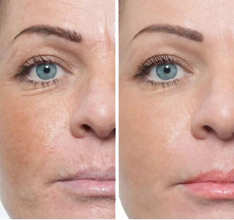 بهترین میکرونیدلینگ