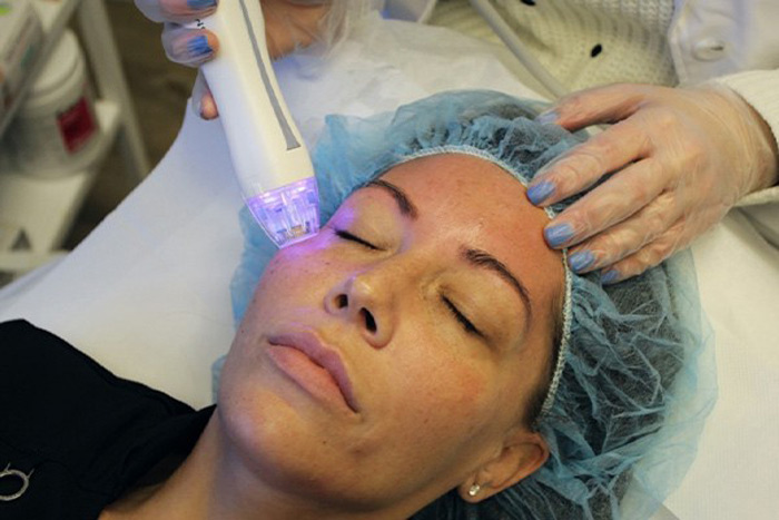 آر اف ویرچو برای احیای پوست