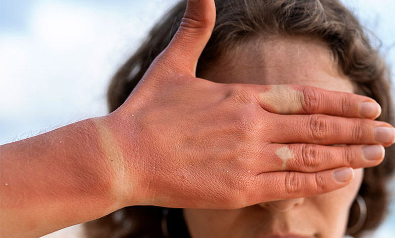 سفید کردن پوست آفتاب سوخته