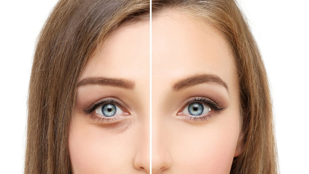 فرق مزوژل با فیلر زیر چشم