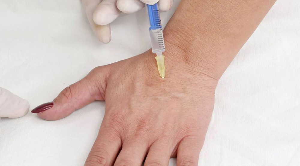 تزریق ژل به پشت دست