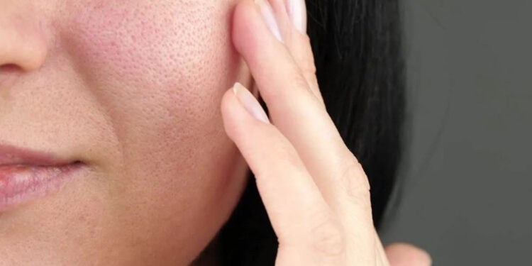 درمان منافذ باز پوست