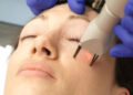 لیزر جوانسازی صورت
