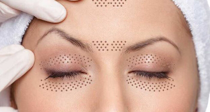 پلاسما درمانی پوست