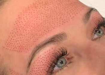 فیبروبلاست تراپی پوست چیست