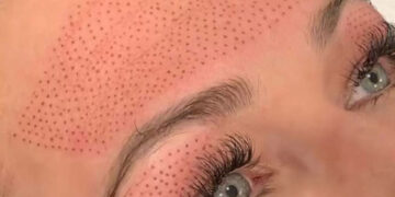 فیبروبلاست تراپی پوست چیست