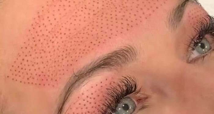 فیبروبلاست تراپی پوست چیست