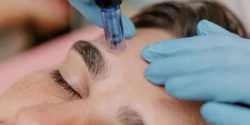 میکرونیدلینگ برای تیرگی پوست