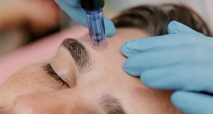 میکرونیدلینگ برای تیرگی پوست