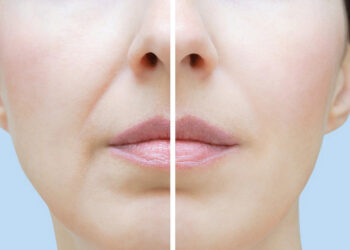 درمان قطعی چین و چروک صورت