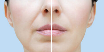 درمان قطعی چین و چروک صورت