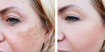 جدیدترین متد جوانسازی صورت