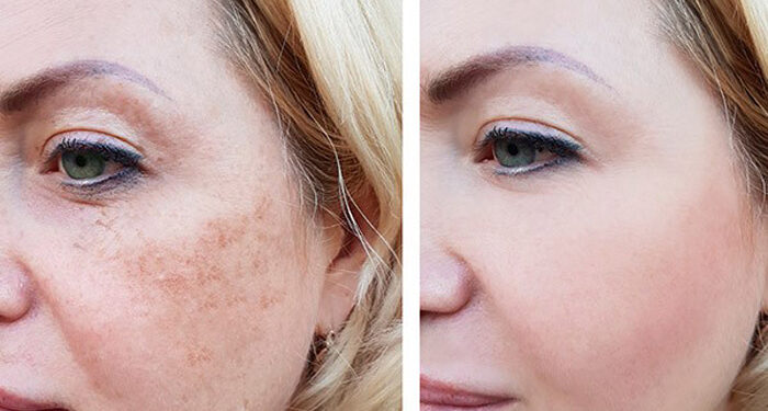 جدیدترین متد جوانسازی صورت