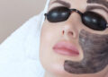 کربن تراپی برای لک صورت
