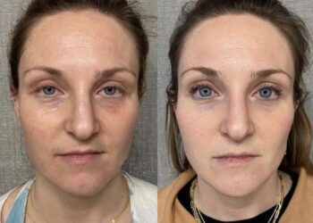 جوانسازی صورت با آر اف ویرچو