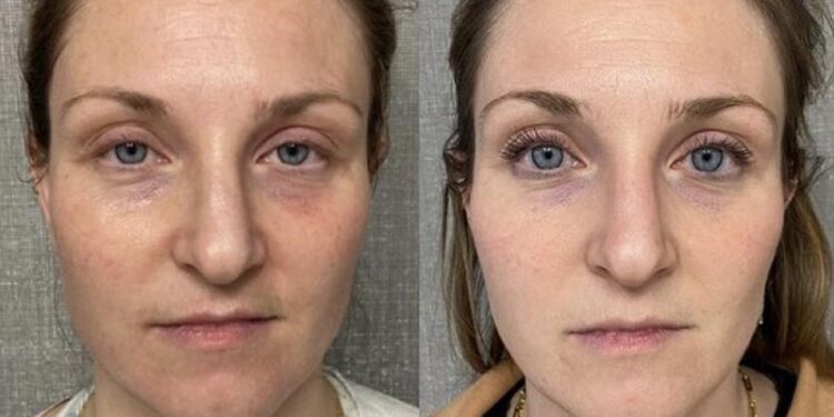 جوانسازی صورت با آر اف ویرچو