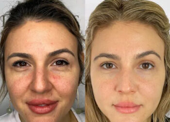 جوانسازی صورت با اسکین بوستر