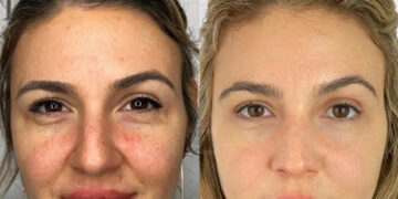 جوانسازی صورت با اسکین بوستر