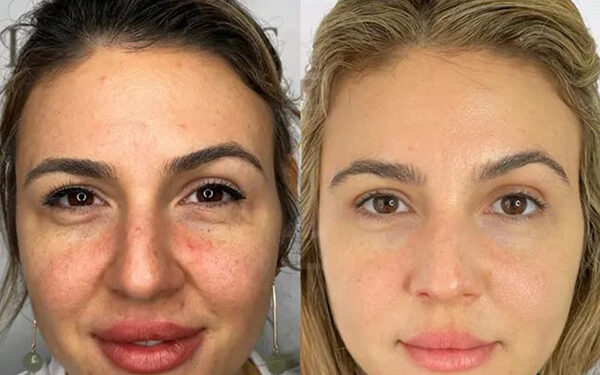 جوانسازی صورت با اسکین بوستر