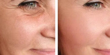 بهترین و سریعترین روش برای جوانسازی و سفتی پوست