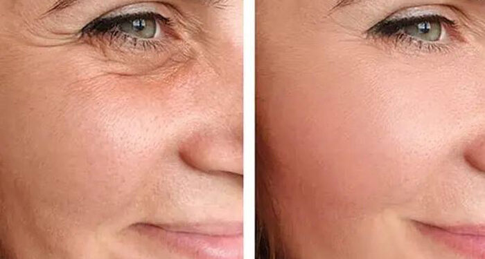 بهترین و سریعترین روش برای جوانسازی و سفتی پوست