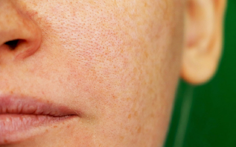 درمان منافذ باز پوست