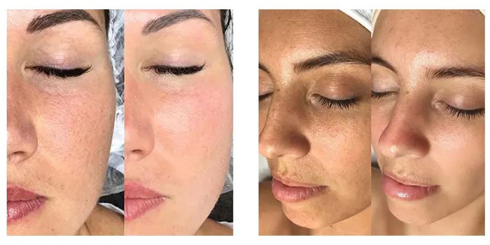 میکرونیدلینگ برای تیرگی پوست