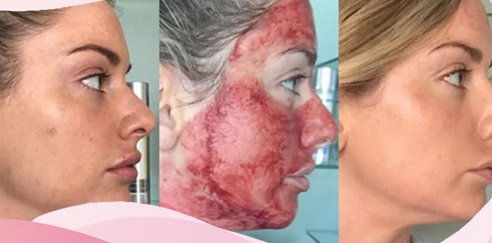 فواید میکرونیدلینگ صورت