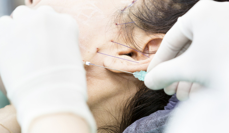 لیفت صورت با نخ کاگ