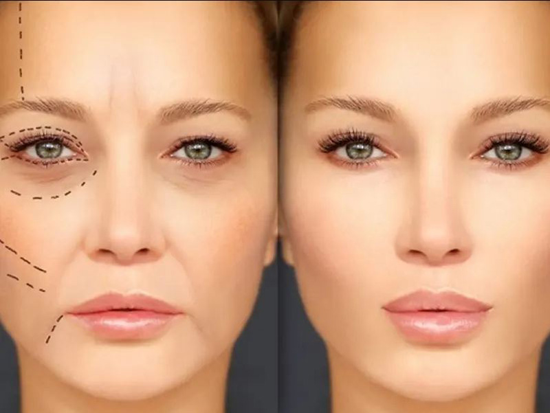 لیفت و جوانسازی صورت