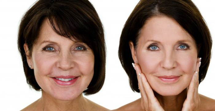 ژل جوانسازی صورت رادیس