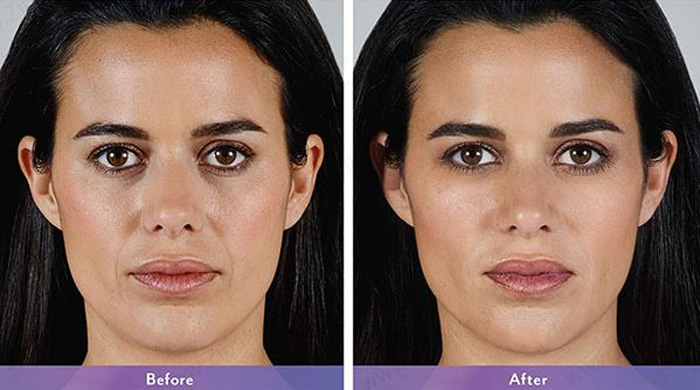 ژل جوانسازی صورت ژوویدرم